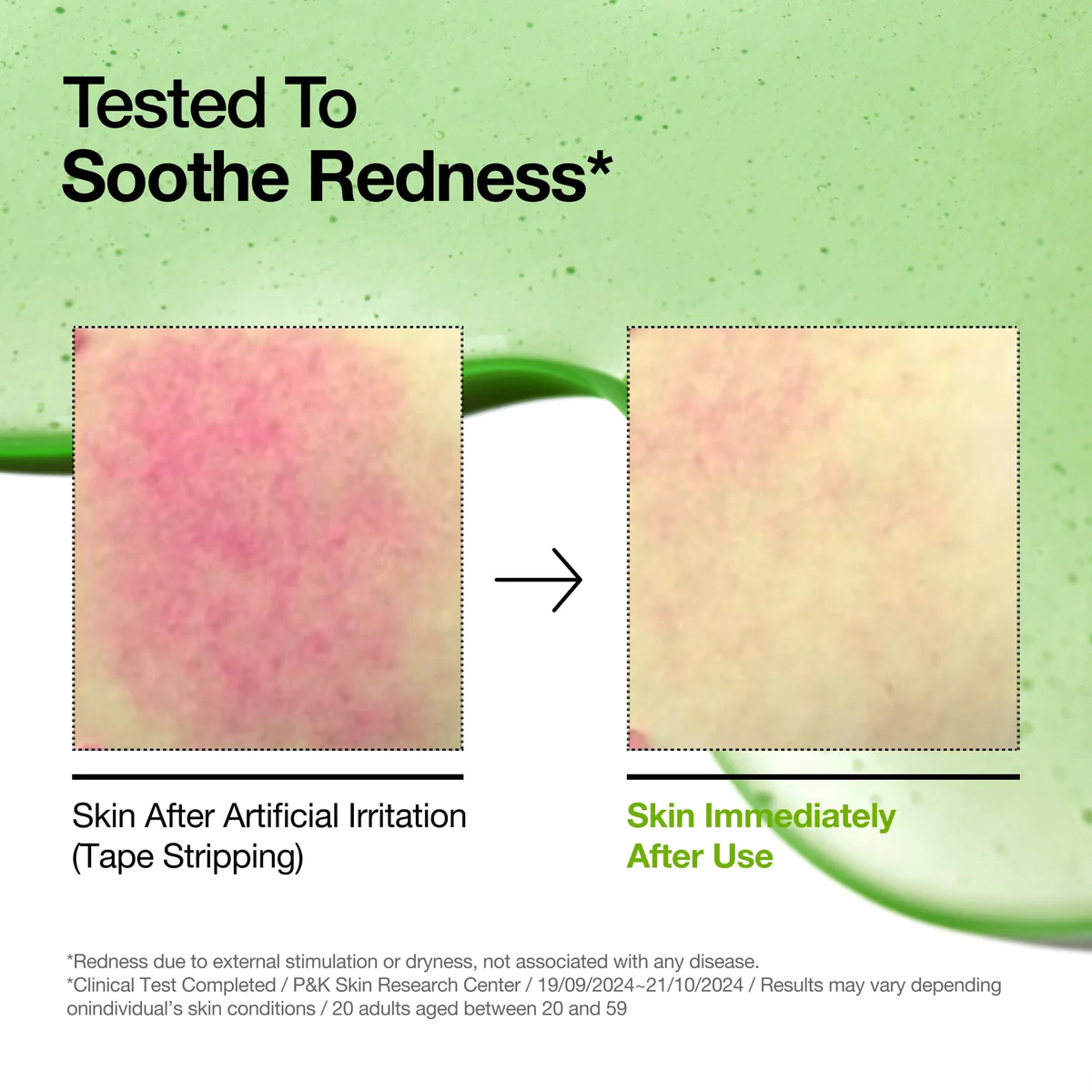 Anua Azelaic Acid 10 Hyaluron Redness Soothing Serum 30ml - κορεάτικος ορός για ερυθρότητα - glowfit.gr